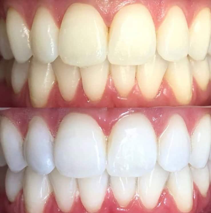 Pola-before-and-after-9 - orthoclear